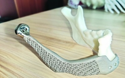 titanium Jaw bone produced by 3D printing